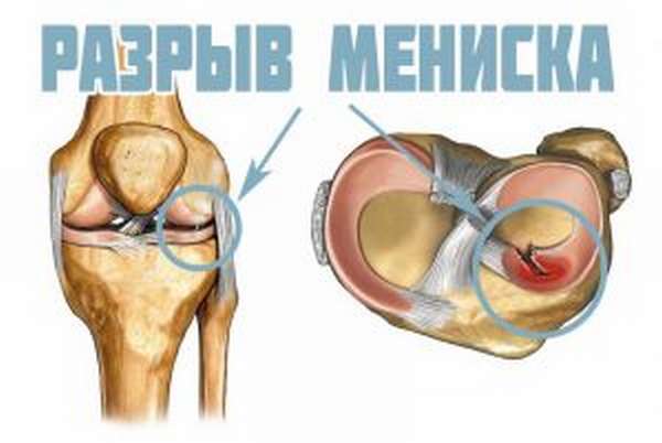 Операция на суставе колена